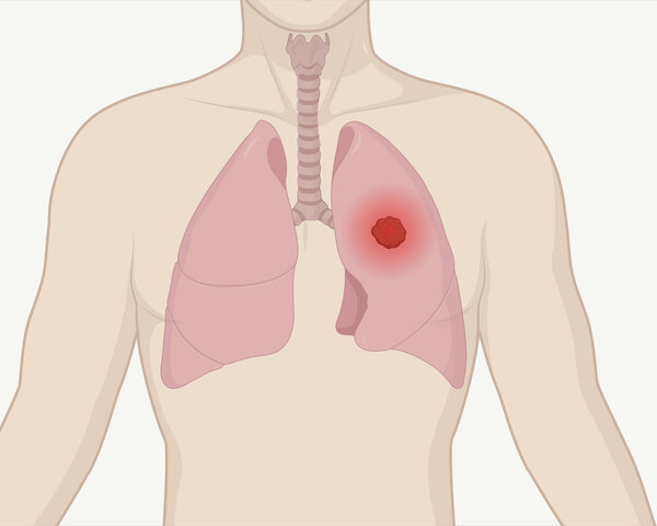 Grafik eines menschlichen Oberkörpers mit Lunge und Luftröhre. Ein Tumor in der Lunge ist als leuchtender Punkt dargestellt.