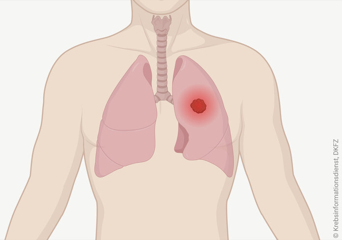 Grafik eines menschlichen Oberkörpers mit Lunge und Luftröhre. Ein Tumor in der Lunge ist als leuchtender Punkt dargestellt.